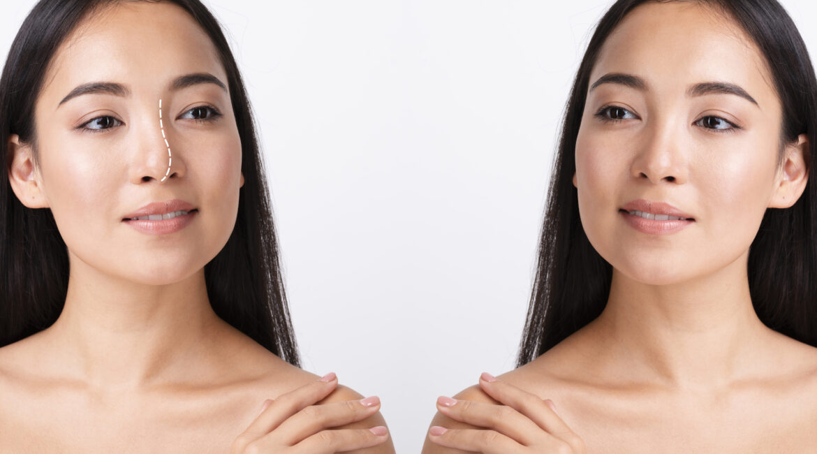 skin booster injection before and after