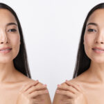 skin booster injection before and after