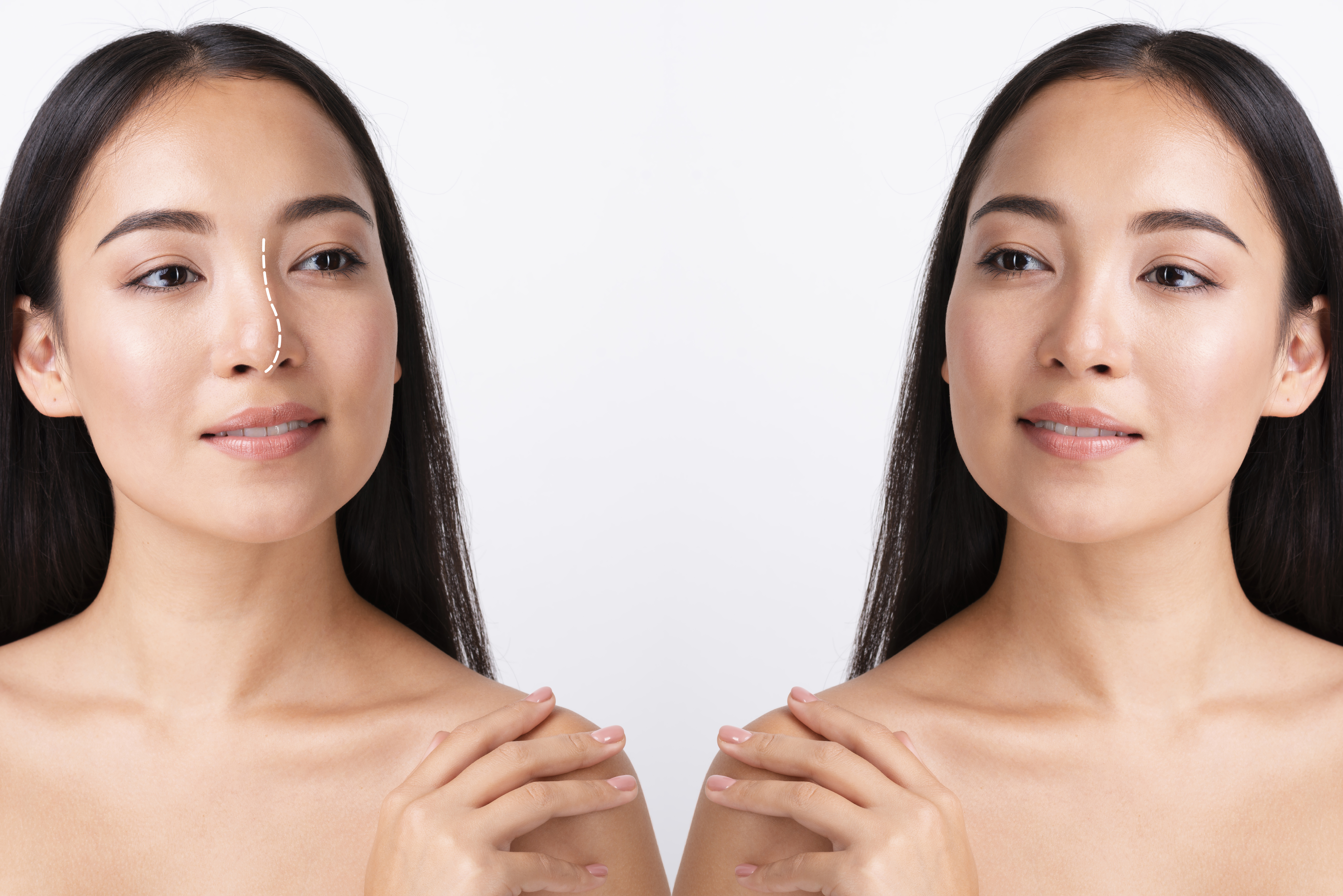 Transform Your Skin: Skin Booster Injection Before and After